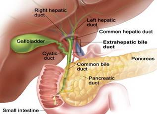 Gallstones