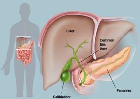 Gallstones