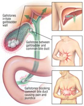 Gallstones