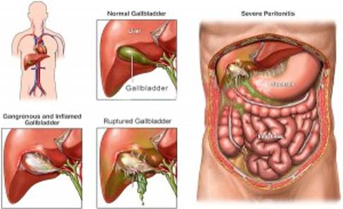 Gallstones