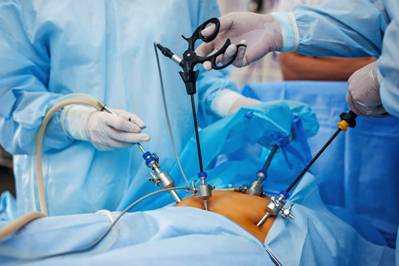 Gallstones