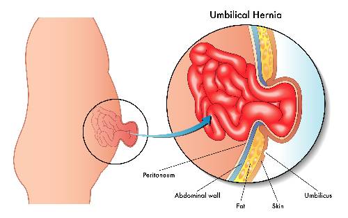 hernia specialist dubai