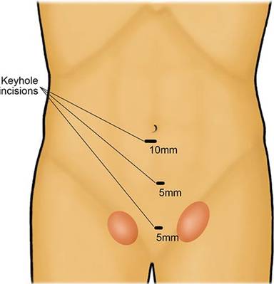 Hernia Repair