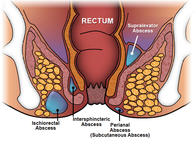 abscess treatment in dubai
