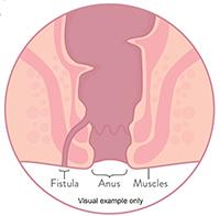 Fistula Treatment in Dubai
